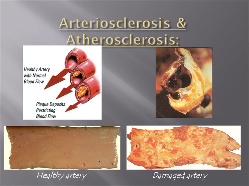Arteriosclerosis & Atherosclerosis:   Healthy artery Damaged artery